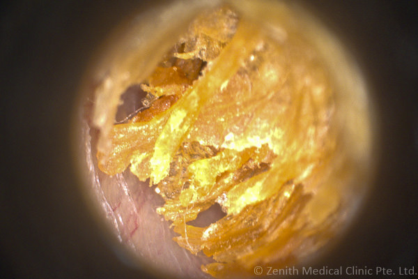 dry type earwax