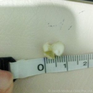 nose_white_thing