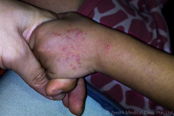 tattoo-rash