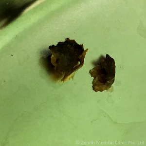 hard-earwax