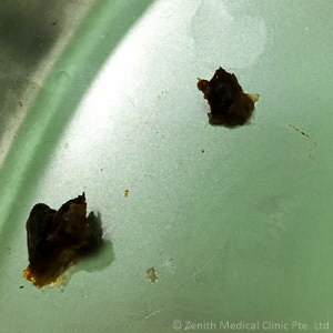 more-hard-earwax
