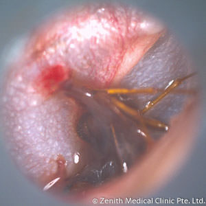 ant in the ear with eardrum injury